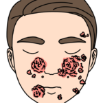 【画像】男性の梅毒患者が女性の2倍に  パパ活買春キモおじ大国ジャパン